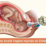 Vaginal Injury